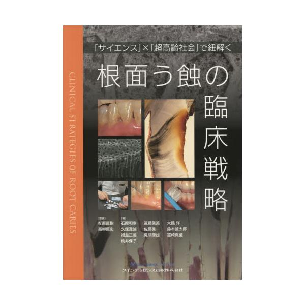 書籍: 根面う蝕の臨床戦略 「サイエンス」×「超高齢社会」で