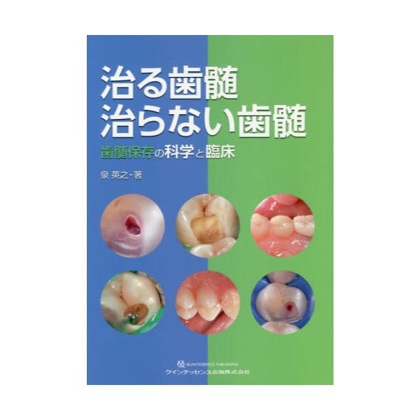 書籍: 治る歯髄治らない歯髄 歯髄保存の科学と臨床: クインテッセンス 